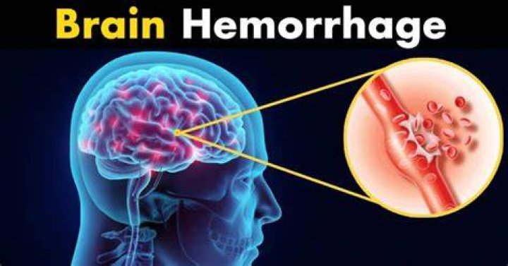 Energy Drinks Cause Brain Hemorrhage