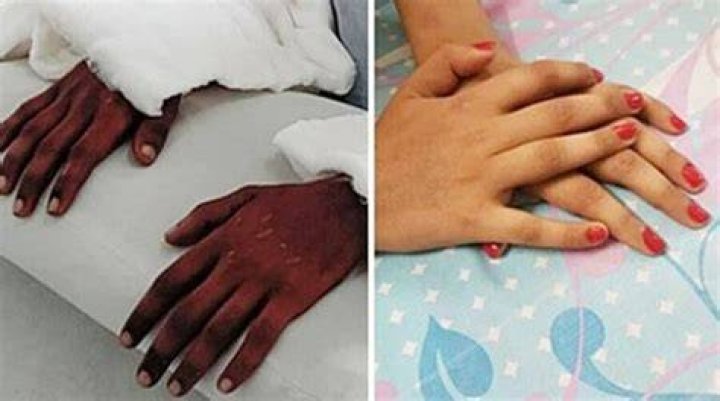 Hand Transplant Changing Skin Color