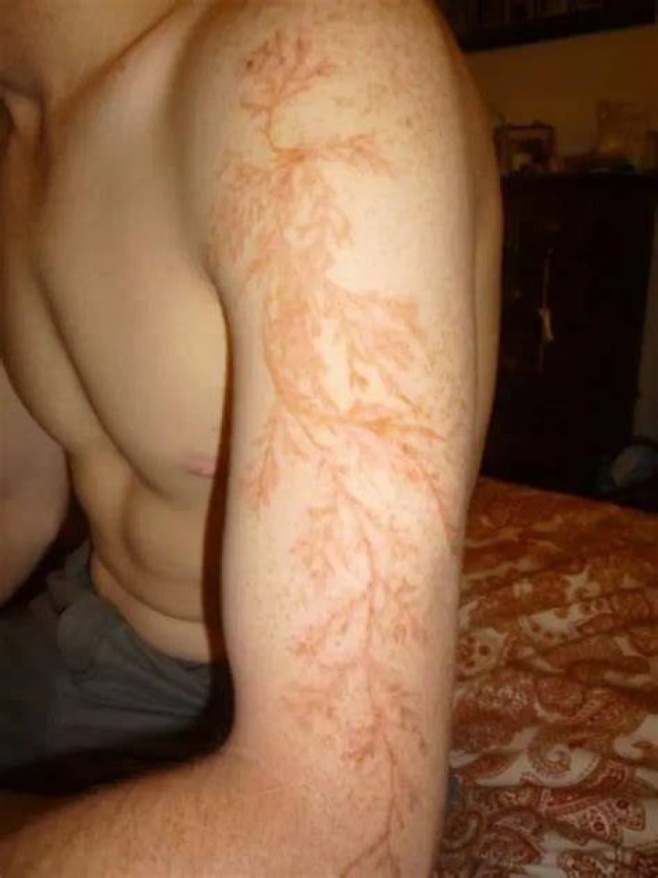 Lichtenberg Scar From Being Struck By Lightning
